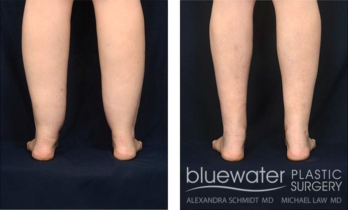 Michael Law MD Aesthetic Plastic Surgery liposuction result — Raleigh, NC