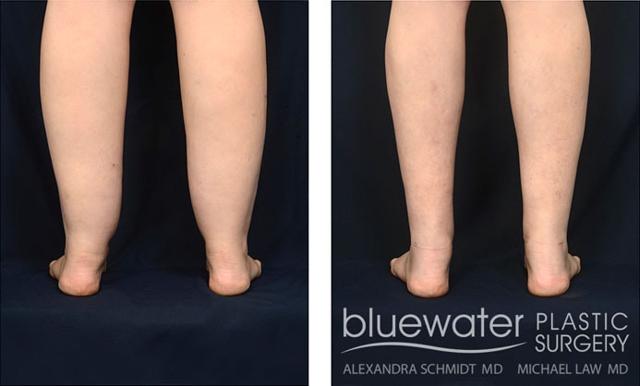 Liposuction result at Michael Law MD Aesthetic Plastic Surgery in Raleigh, NC