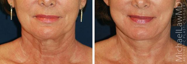 Neck Lift result at Michael Law MD Aesthetic Plastic Surgery in Raleigh, NC