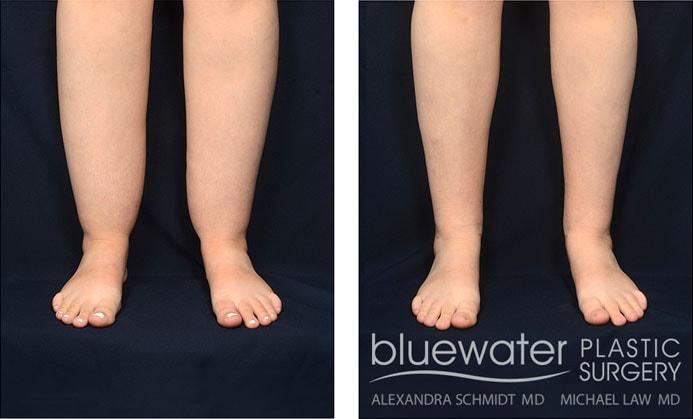 Michael Law MD Aesthetic Plastic Surgery liposuction result — Raleigh, NC