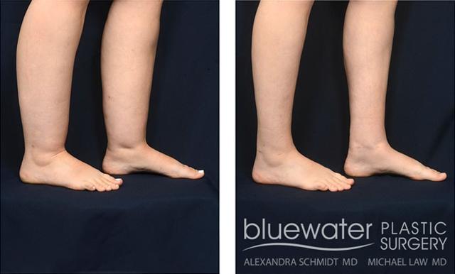 Liposuction result at Michael Law MD Aesthetic Plastic Surgery in Raleigh, NC