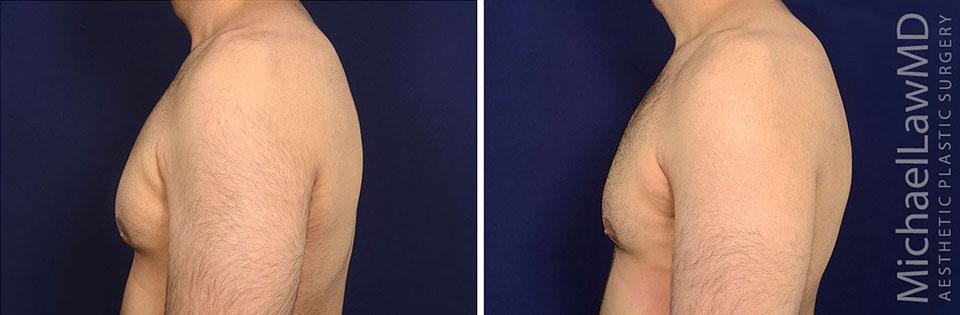 Michael Law MD Aesthetic Plastic Surgery gynecomastia result — Raleigh, NC