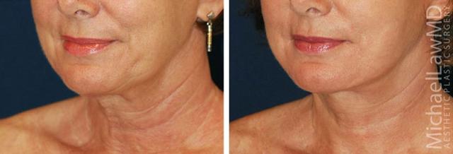 Neck Lift result at Michael Law MD Aesthetic Plastic Surgery in Raleigh, NC