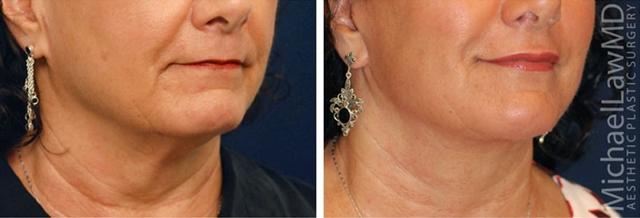 Neck Lift result at Michael Law MD Aesthetic Plastic Surgery in Raleigh, NC