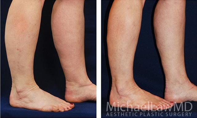 Liposuction result at Michael Law MD Aesthetic Plastic Surgery in Raleigh, NC