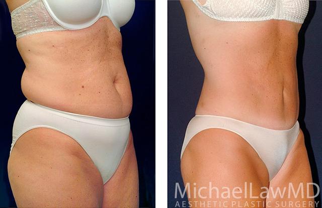 Tummy Tuck result at Michael Law MD Aesthetic Plastic Surgery in Raleigh, NC