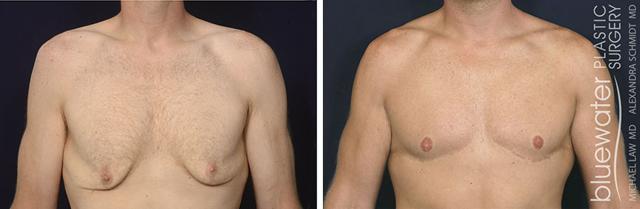 Gynecomastia Surgery result at Michael Law MD Aesthetic Plastic Surgery in Raleigh, NC
