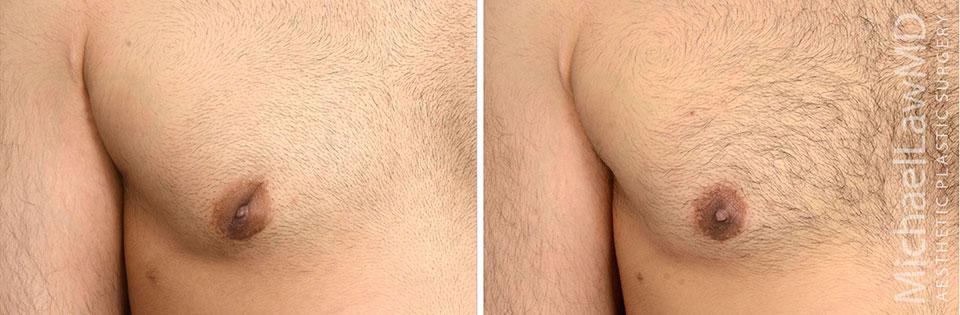 Michael Law MD Aesthetic Plastic Surgery gynecomastia result — Raleigh, NC
