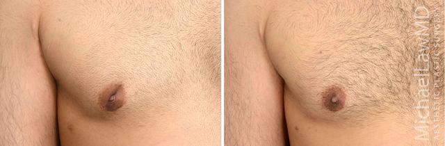 Gynecomastia Surgery result at Michael Law MD Aesthetic Plastic Surgery in Raleigh, NC