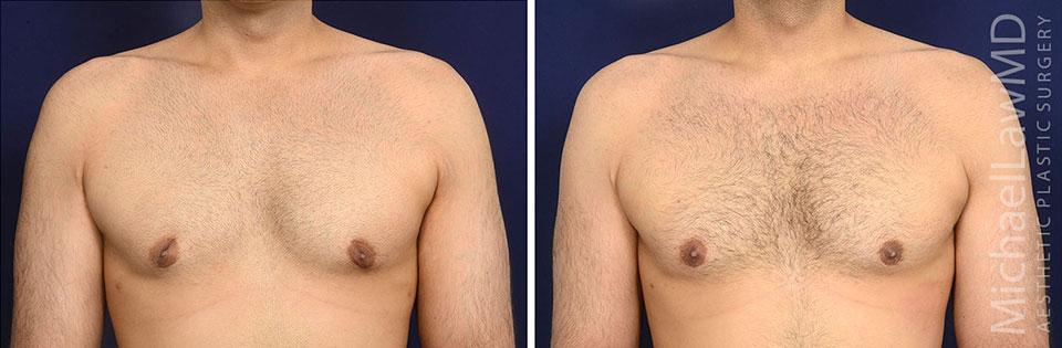 Michael Law MD Aesthetic Plastic Surgery gynecomastia result — Raleigh, NC