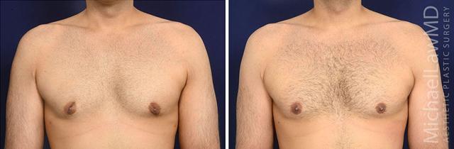 Gynecomastia Surgery result at Michael Law MD Aesthetic Plastic Surgery in Raleigh, NC
