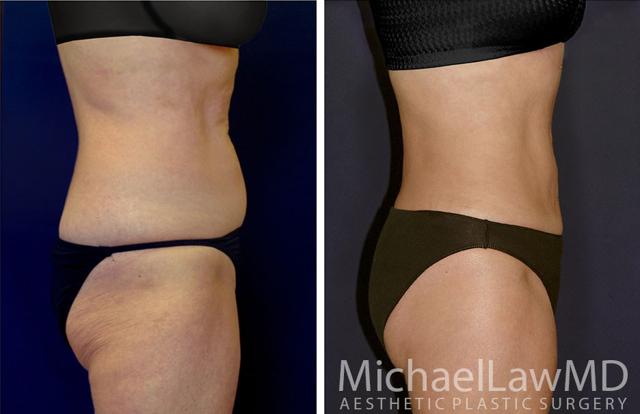 Tummy Tuck result at Michael Law MD Aesthetic Plastic Surgery in Raleigh, NC