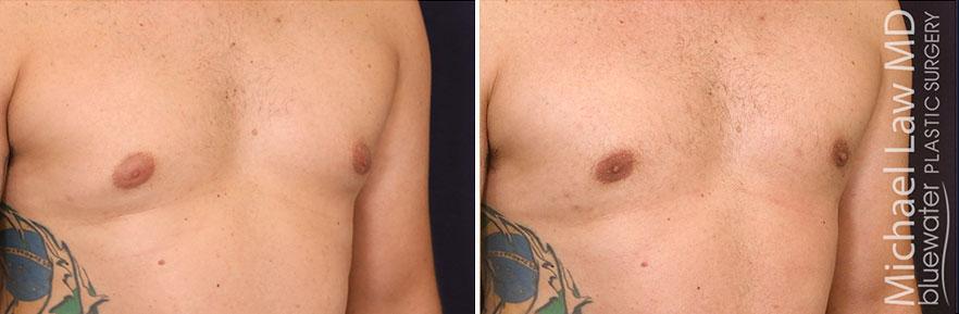 Michael Law MD Aesthetic Plastic Surgery gynecomastia result — Raleigh, NC