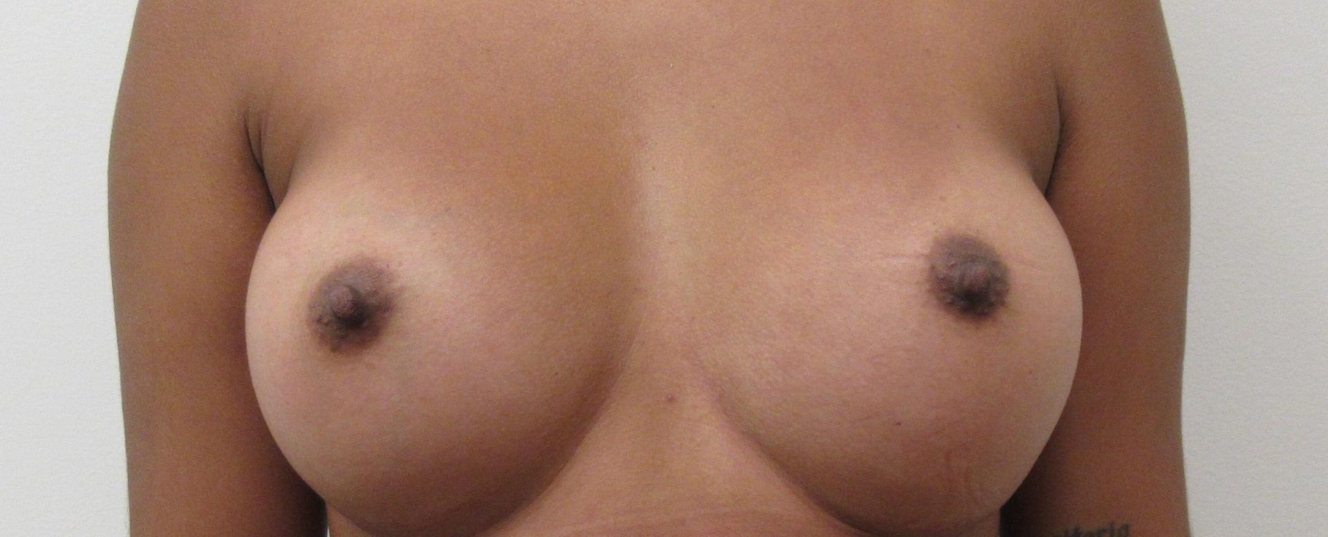 Prima Center for Plastic Surgery breast augmentation after — Duluth, GA