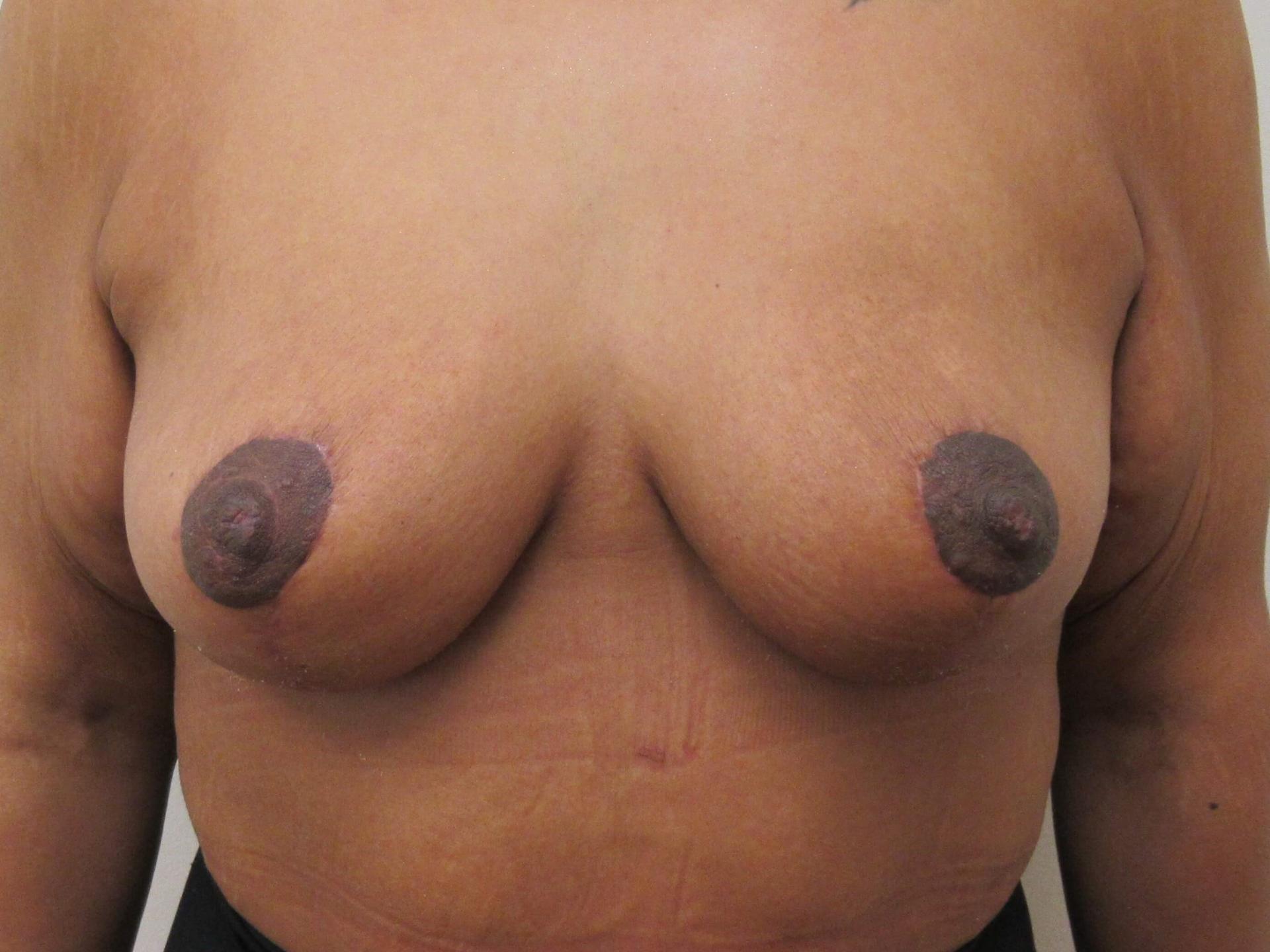 Prima Center for Plastic Surgery breast reduction after — Duluth, GA