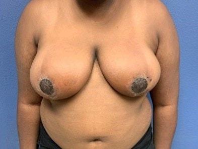 Prima Center for Plastic Surgery breast reduction after — Duluth, GA