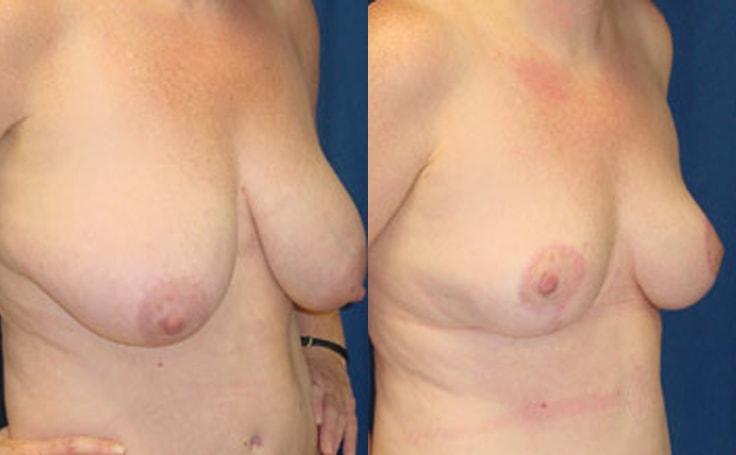 Ricardo L. Rodriguez, MD breast reduction result — Lutherville, MD