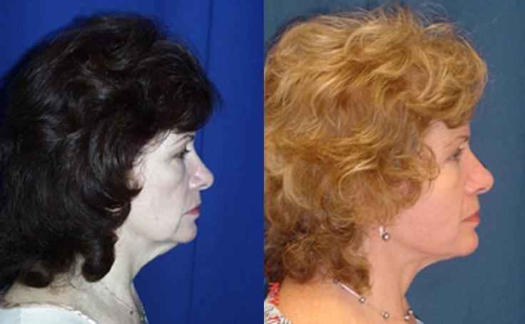 Ricardo L. Rodriguez, MD neck lift result — Lutherville, MD