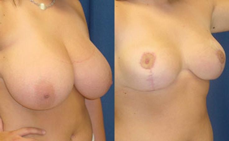 Ricardo L. Rodriguez, MD breast reduction result — Lutherville, MD
