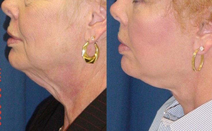 Ricardo L. Rodriguez, MD neck lift result — Lutherville, MD