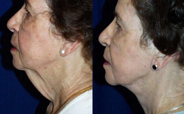 Ricardo L. Rodriguez, MD neck lift result — Lutherville, MD
