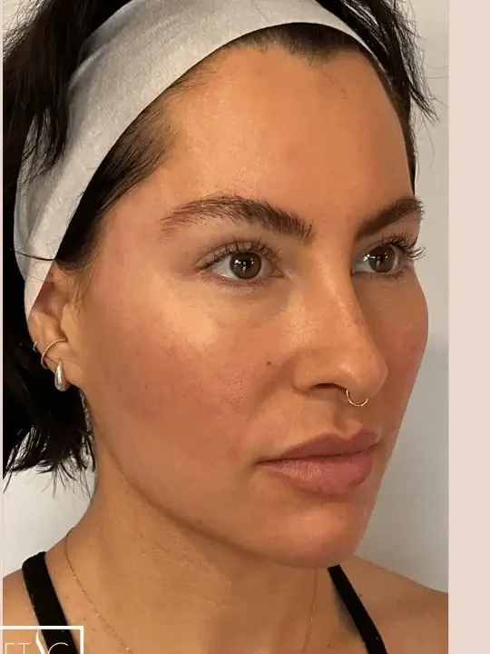 Facelift after at Esthetic Finesse in Paradise Valley, AZ