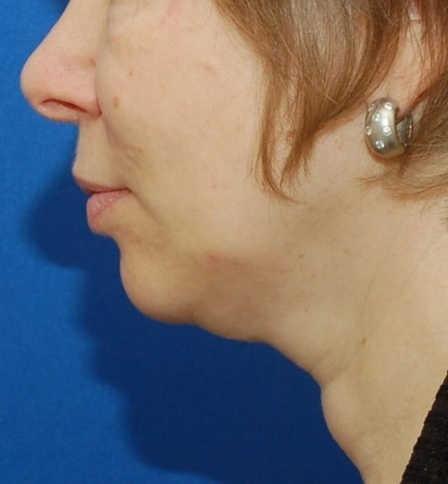 Neck Liposuction before at L Plastic Surgery (Charles K Lee, MD) in San Francisco, CA