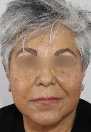 L Plastic Surgery (Charles K Lee, MD) facelift after — San Francisco, CA