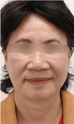 L Plastic Surgery (Charles K Lee, MD) facelift after — San Francisco, CA
