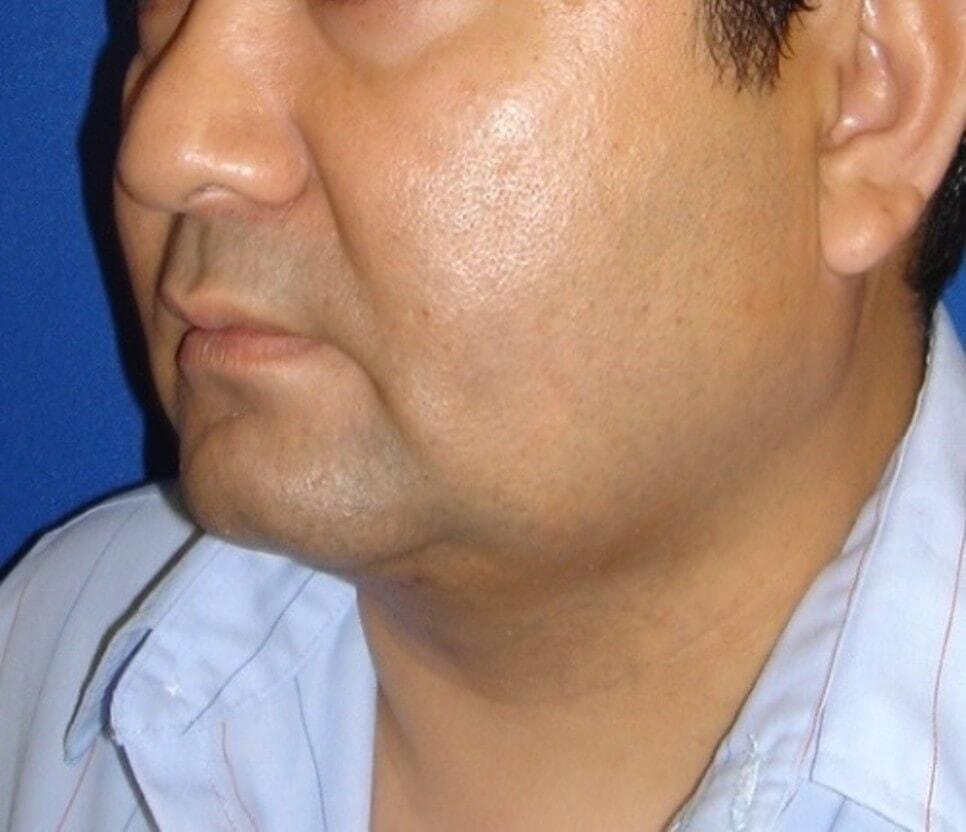 L Plastic Surgery (Charles K Lee, MD) neck lift after — San Francisco, CA