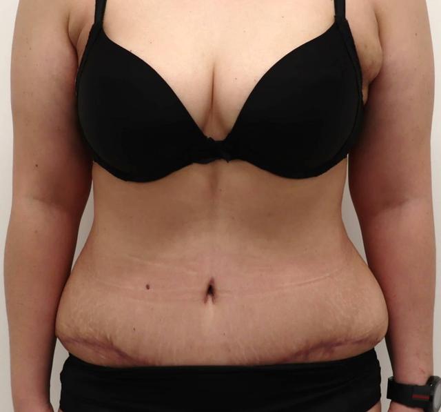 Mini Tummy Tuck after at L Plastic Surgery (Charles K Lee, MD) in San Francisco, CA