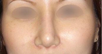 L Plastic Surgery (Charles K Lee, MD) rhinoplasty after — San Francisco, CA
