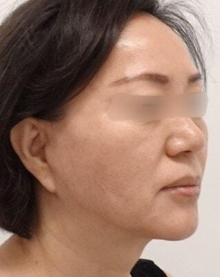 L Plastic Surgery (Charles K Lee, MD) facelift after — San Francisco, CA