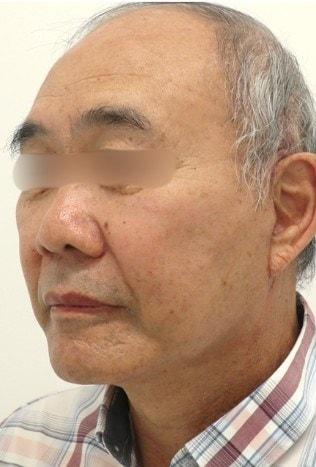 L Plastic Surgery (Charles K Lee, MD) facelift after — San Francisco, CA