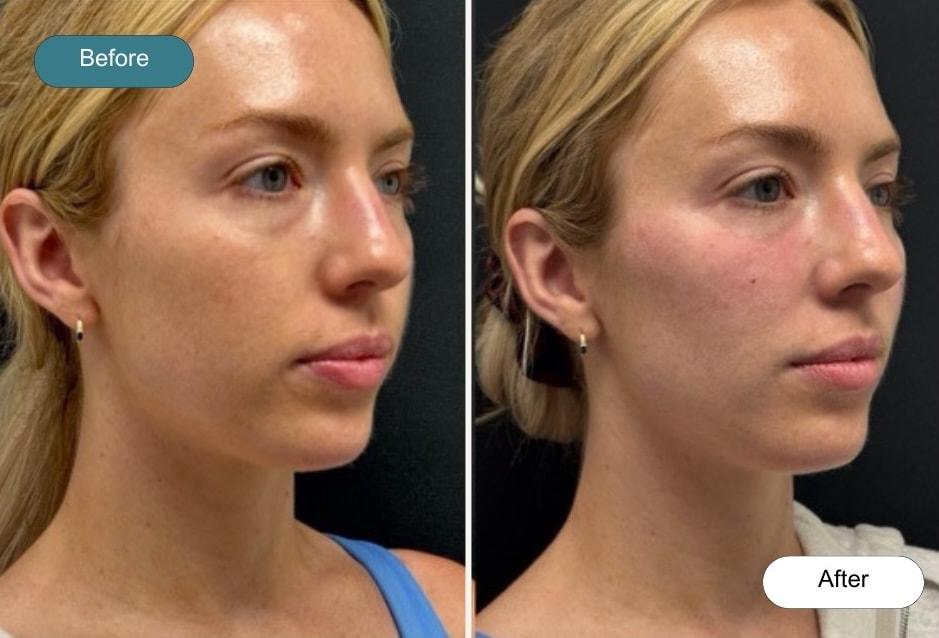 Dvida Spa | Med Spa Services 60654 under-eye filler result — Chicago, IL