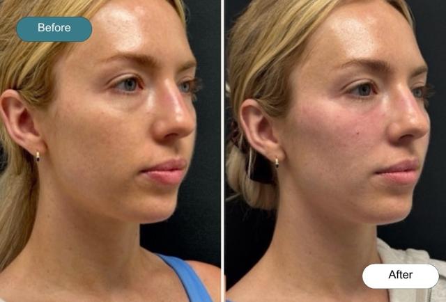 Juvederm result at Dvida Spa | Med Spa Services 60654 in Chicago, IL