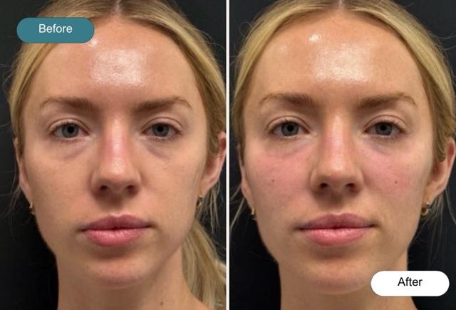 Juvederm result at Dvida Spa | Med Spa Services 60654 in Chicago, IL