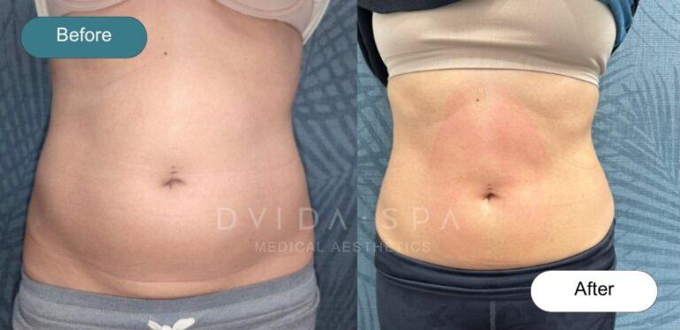 Dvida Spa | Med Spa Services 60654 coolsculpting result — Chicago, IL