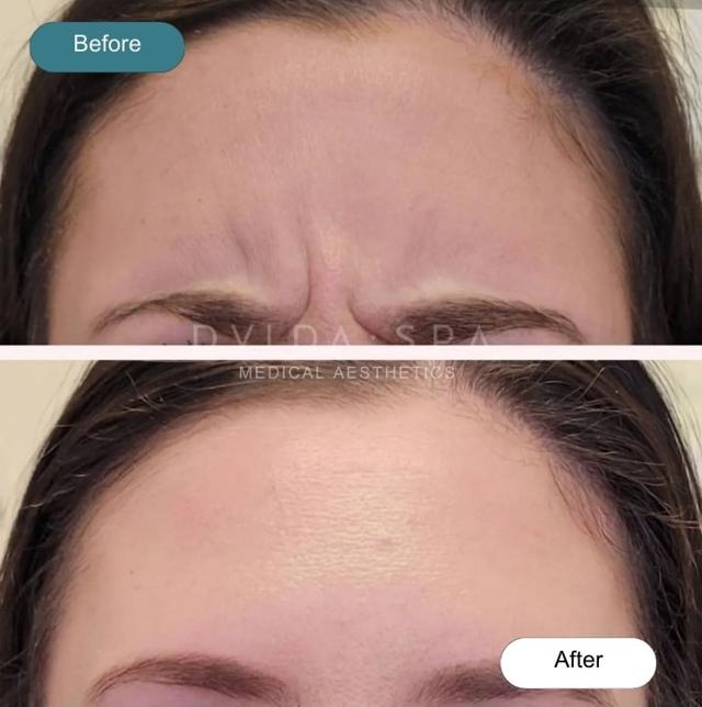 Botox result at Dvida Spa | Med Spa Services 60654 in Chicago, IL