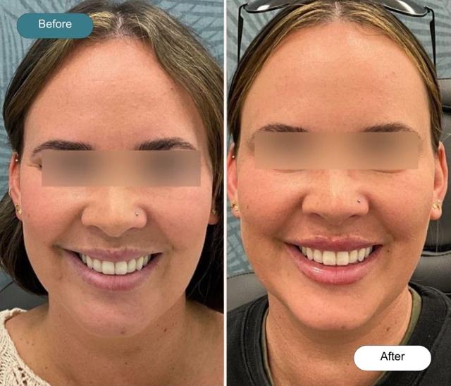 Lip Filler result at Dvida Spa | Med Spa Services 60654 in Chicago, IL