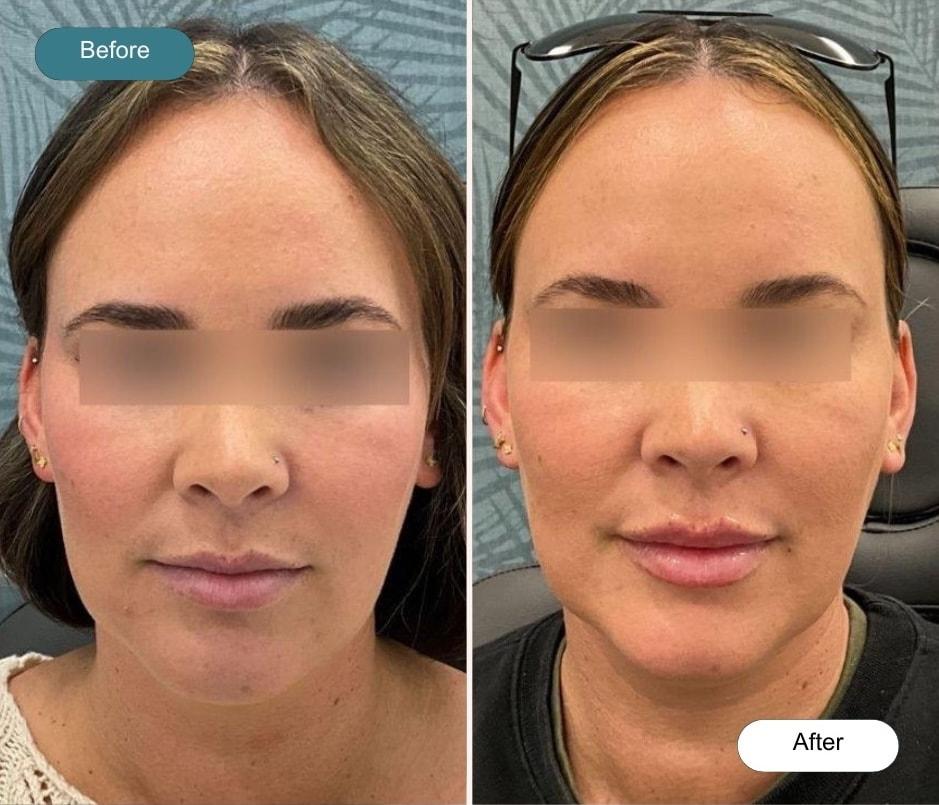 Dvida Spa | Med Spa Services 60654 lip filler result — Chicago, IL