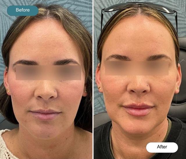 Lip Filler result at Dvida Spa | Med Spa Services 60654 in Chicago, IL