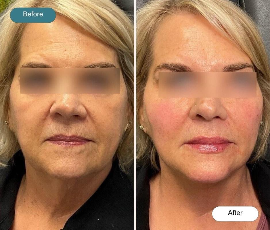 Dvida Spa | Med Spa Services 60654 lip filler result — Chicago, IL