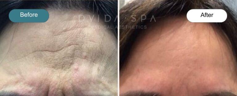 Dvida Spa | Med Spa Services 60654 botox result — Chicago, IL