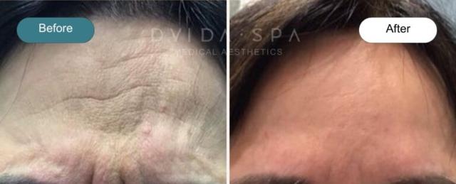 Botox result at Dvida Spa | Med Spa Services 60654 in Chicago, IL