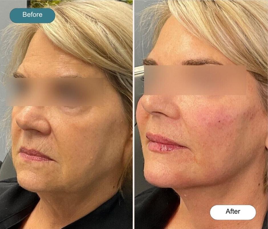 Dvida Spa | Med Spa Services 60654 lip filler result — Chicago, IL