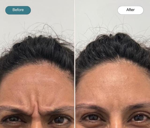 Botox result at Dvida Spa | Med Spa Services 60654 in Chicago, IL
