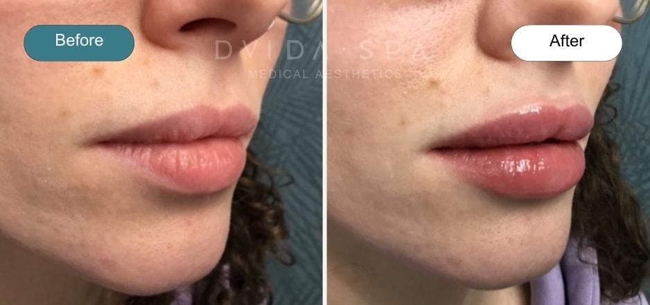 Dvida Spa | Med Spa Services 60654 lip filler result — Chicago, IL