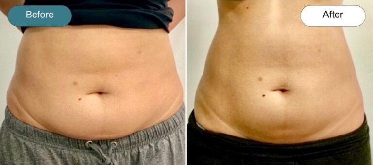 Dvida Spa | Med Spa Services 60654 coolsculpting result — Chicago, IL