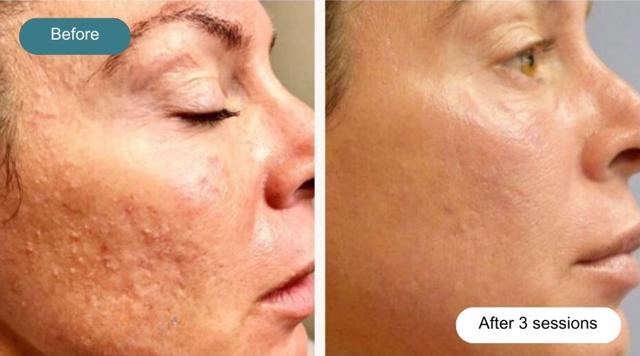 Laser Skin Resurfacing result at Dvida Spa | Med Spa Services 60654 in Chicago, IL